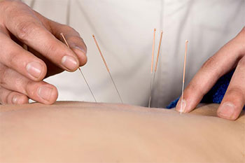 acupuncture