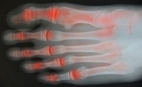 Rheumatoid Arthritis and Chiropractic Help
